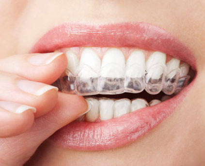 gutiera bruxism